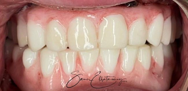 After Full Mouth Rehabilitation