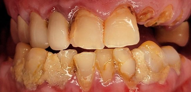 Before Full Mouth Rehabilitation