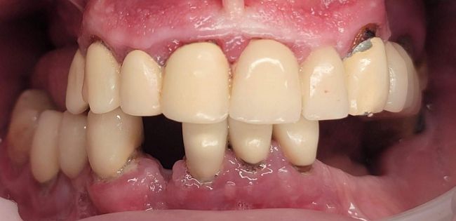 Before Dental Veneers