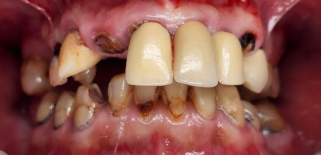 Before Full Mouth Rehabilitation