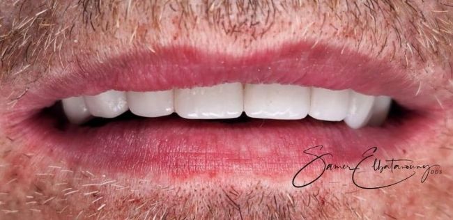 After Dental Veneers