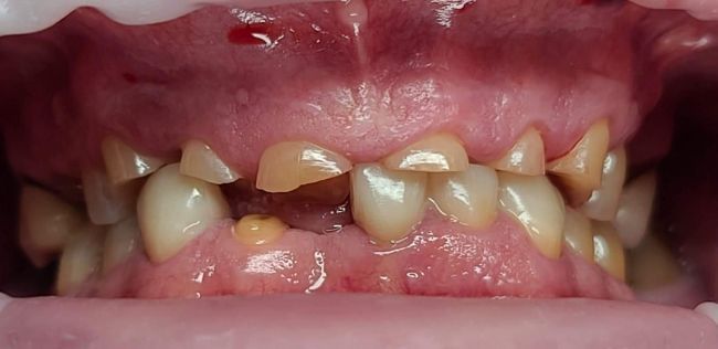 Before Full Mouth Rehabilitation