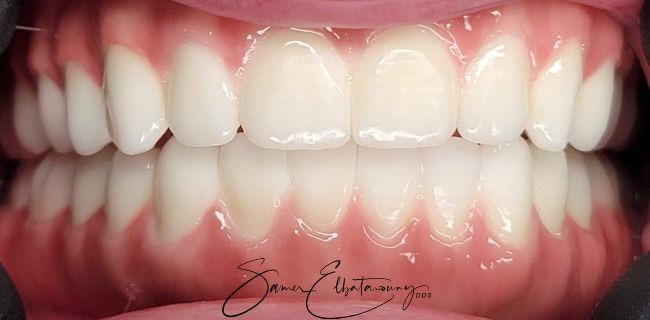 After Full Mouth Rehabilitation