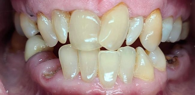 Before Gum Contouring