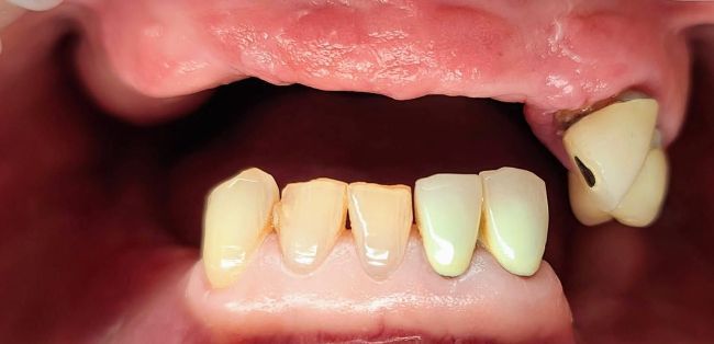 Before Full Mouth Rehabilitation