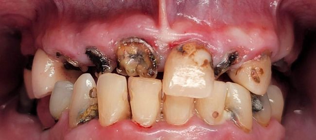 Before Full Mouth Rehabilitation
