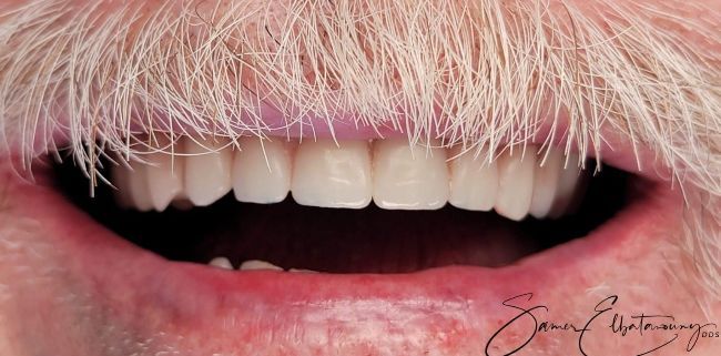 After Full Mouth Rehabilitation