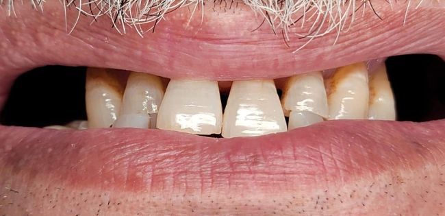 Before Gum Contouring