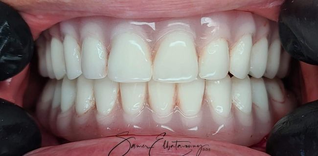 After Full Mouth Rehabilitation