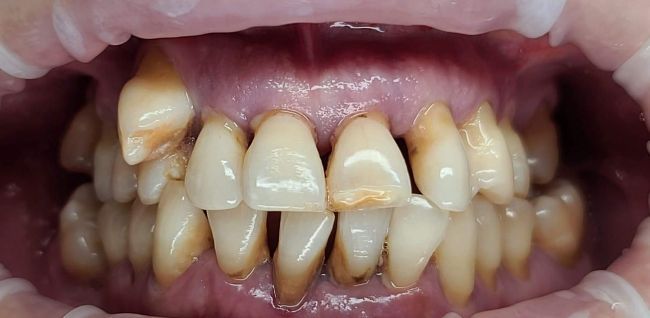 Before Full Mouth Rehabilitation