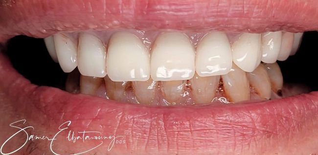 After Full Mouth Rehabilitation
