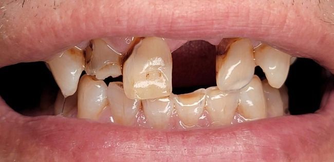 Before Full Mouth Rehabilitation