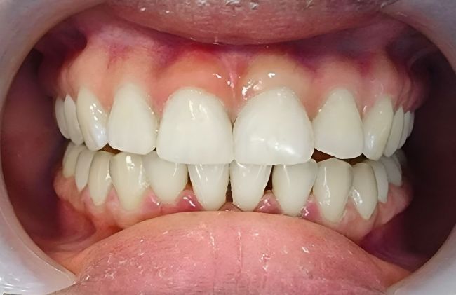 After Orthodontics