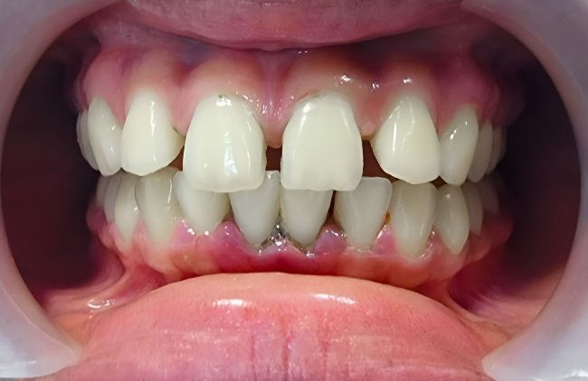 Before Orthodontics