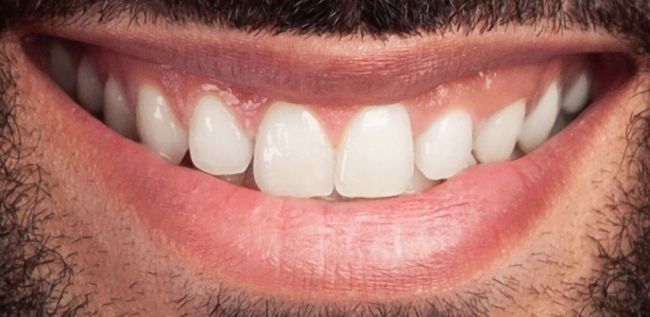Después Blanqueamiento dental