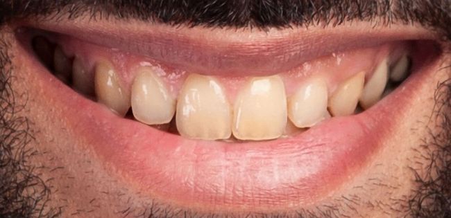 Antes Blanqueamiento dental