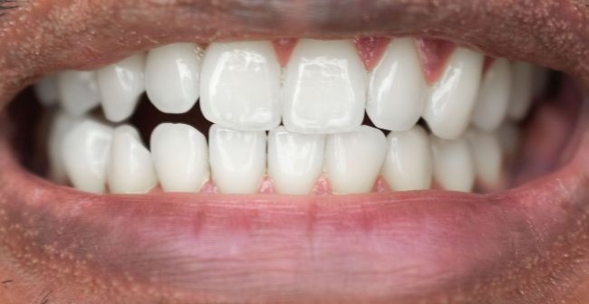 Después Blanqueamiento dental