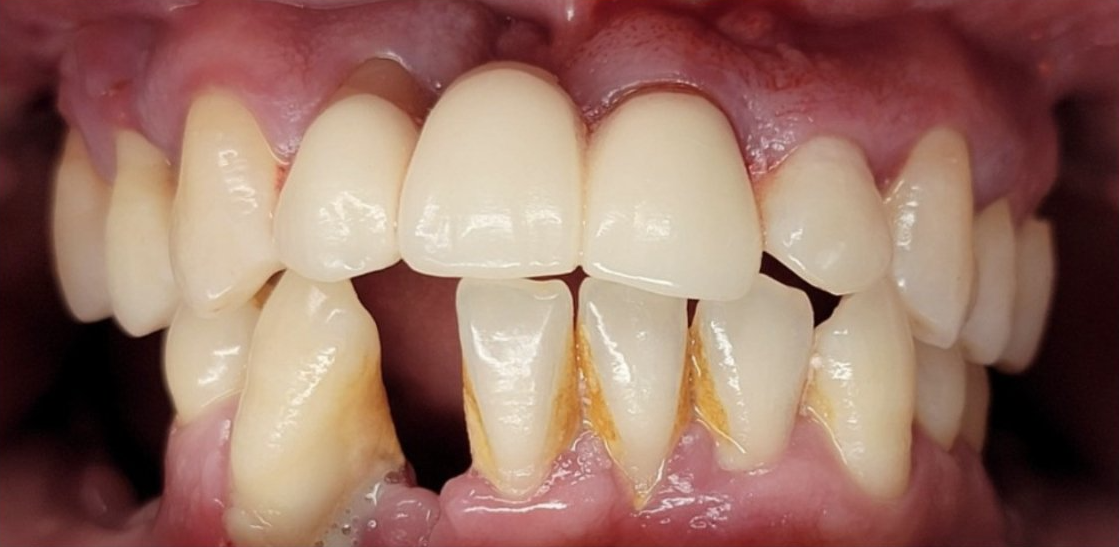 Before Full Mouth Rehabilitation