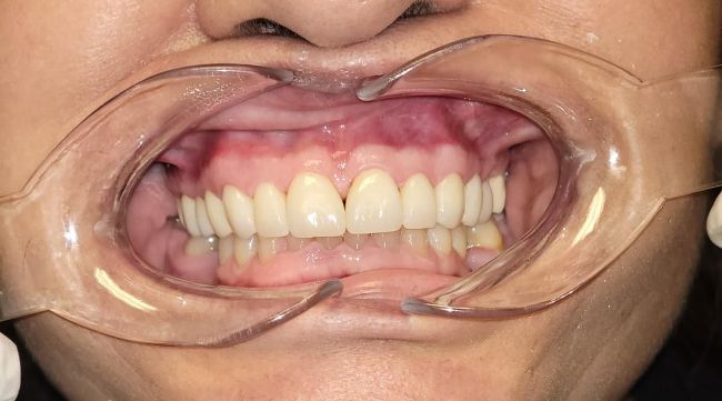 After Orthodontics