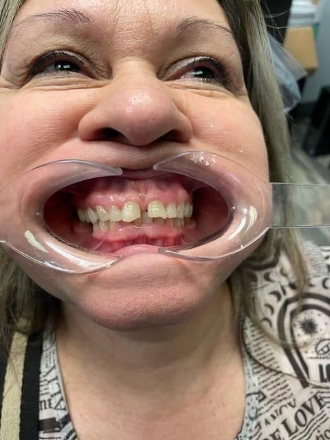 Before Orthodontics