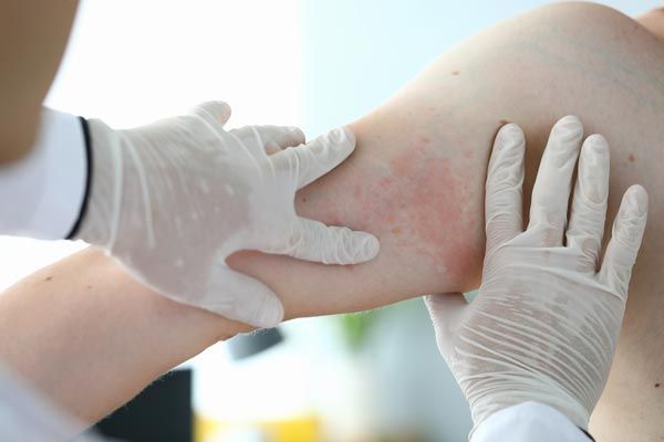 psoriasis