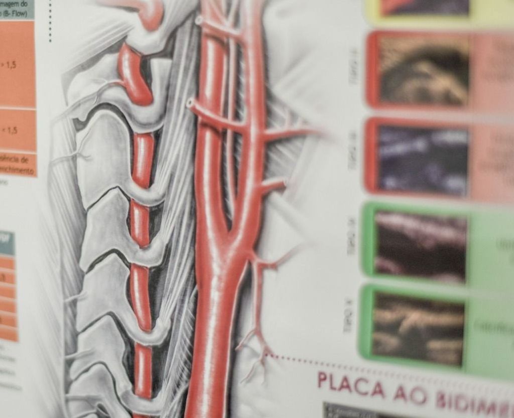 Diagrama da medula espinhal e artérias humanas em vermelho, em um gráfico médico.