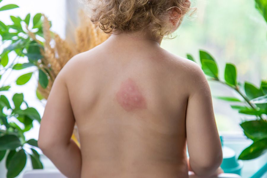 Bed Bugs Bites