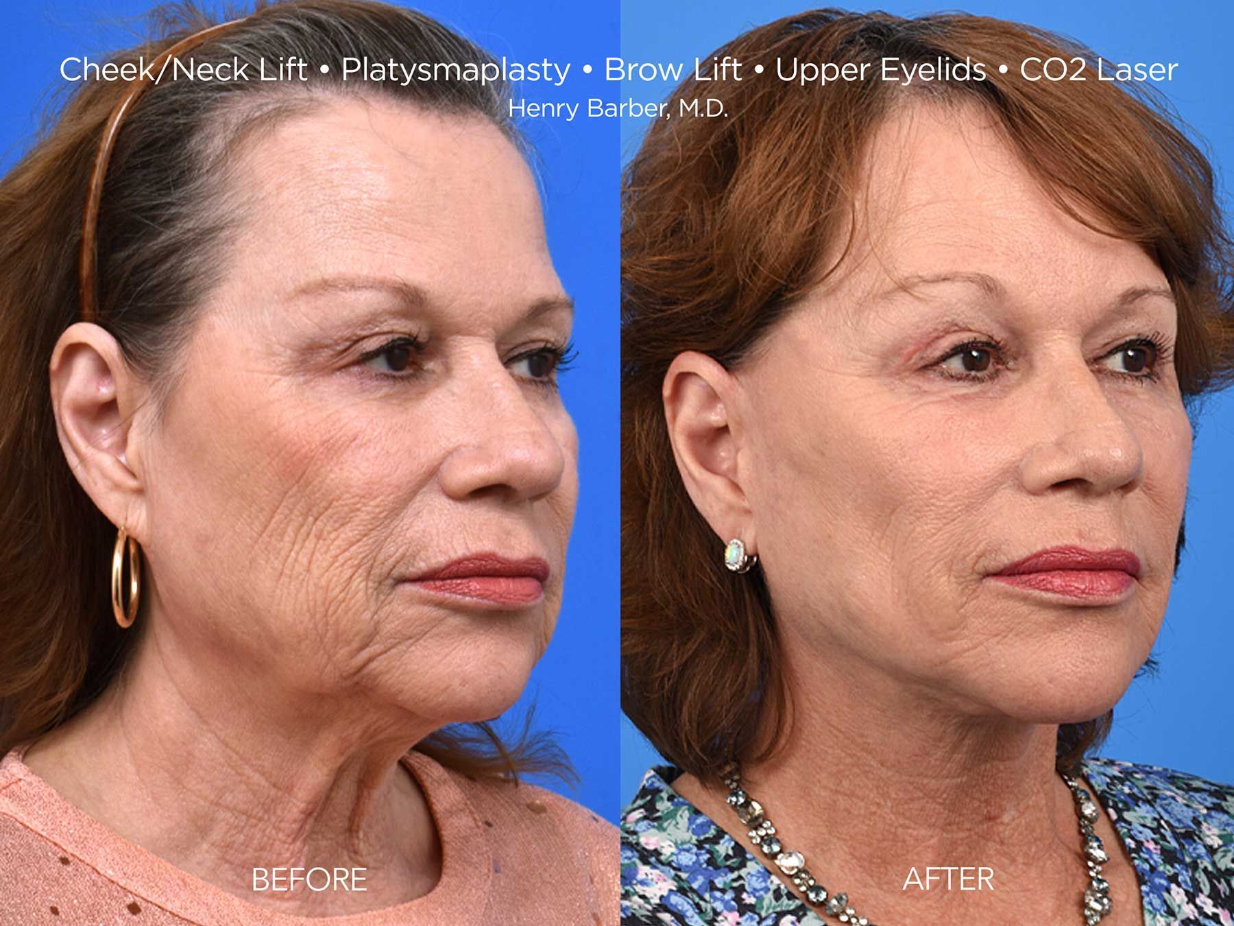 client at barber facial plastic surgery before and after cheek and neck lift- mobile al henry barber