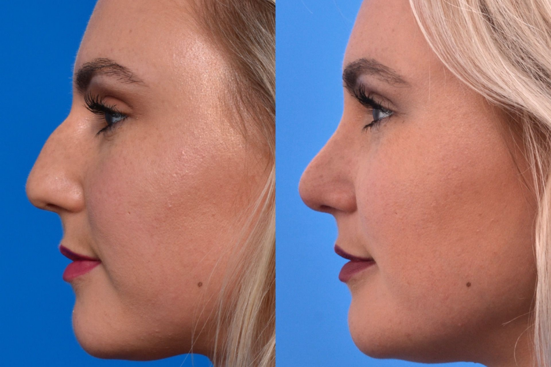 patient at barber facial plastic surgery before and after rhinoplasty