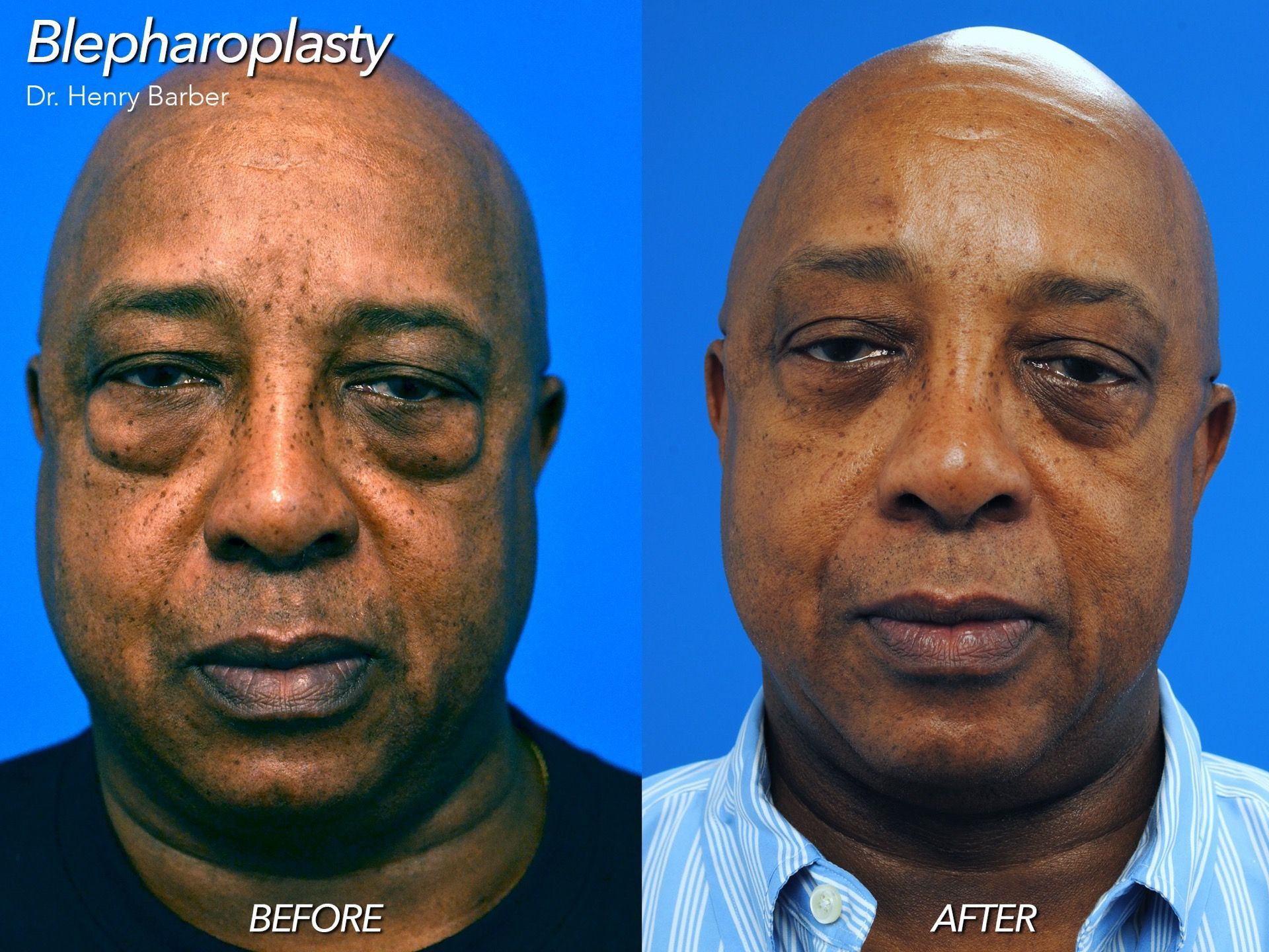 patient at barber facial plastic surgery before and after blepharoplasty