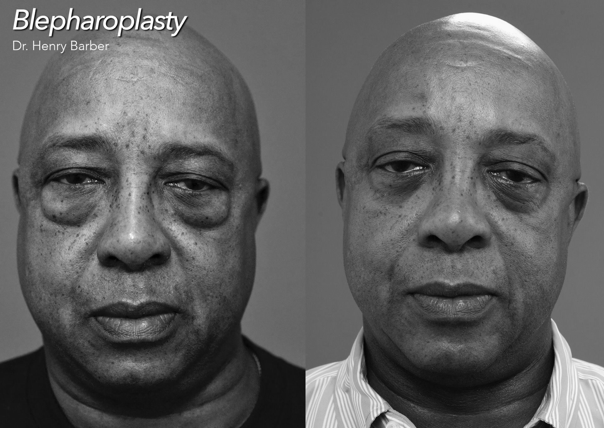 before and after blepharoplasty - barber facial plastic surgery