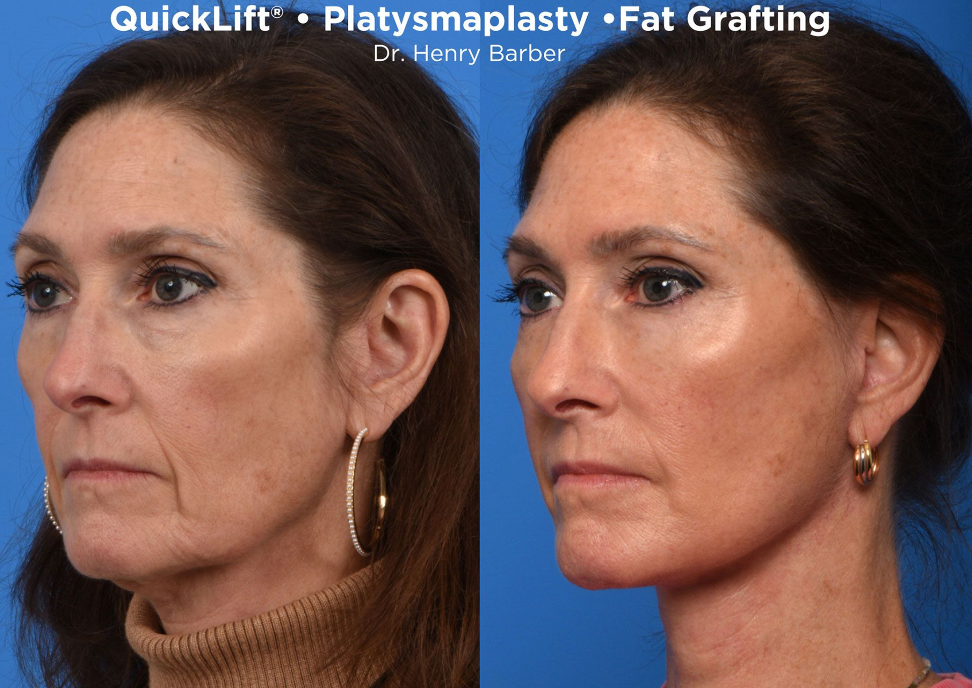 patient at barber facial plastic surgery before and after quicklift