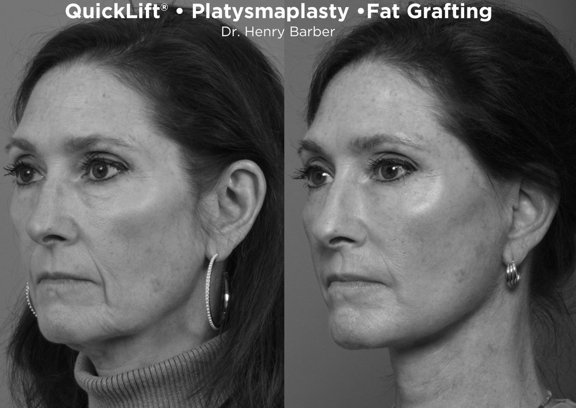 before and after quicklift - barber facial plastic surgery