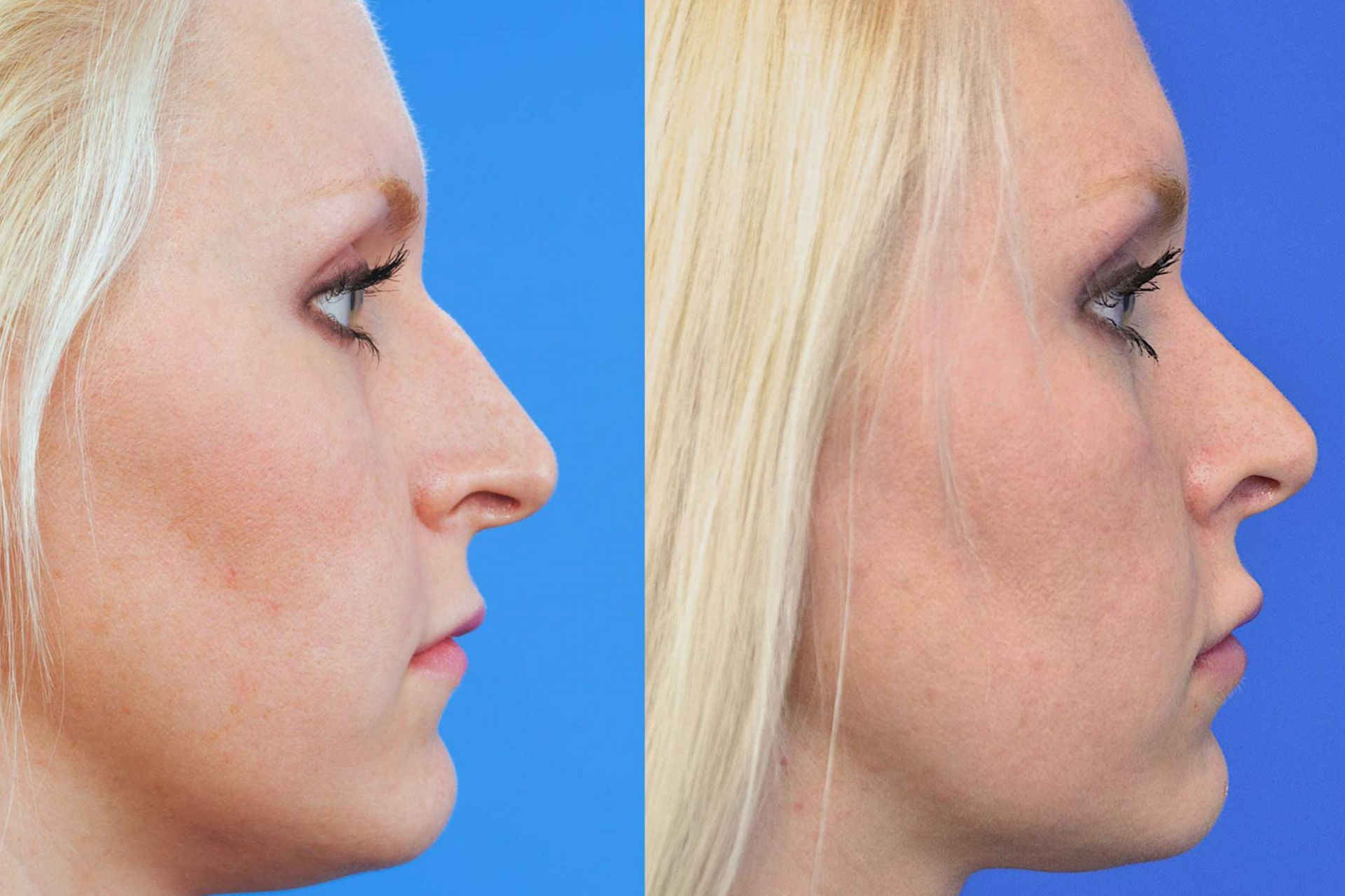 patient at barber facial plastic surgery before and after rhinoplasty