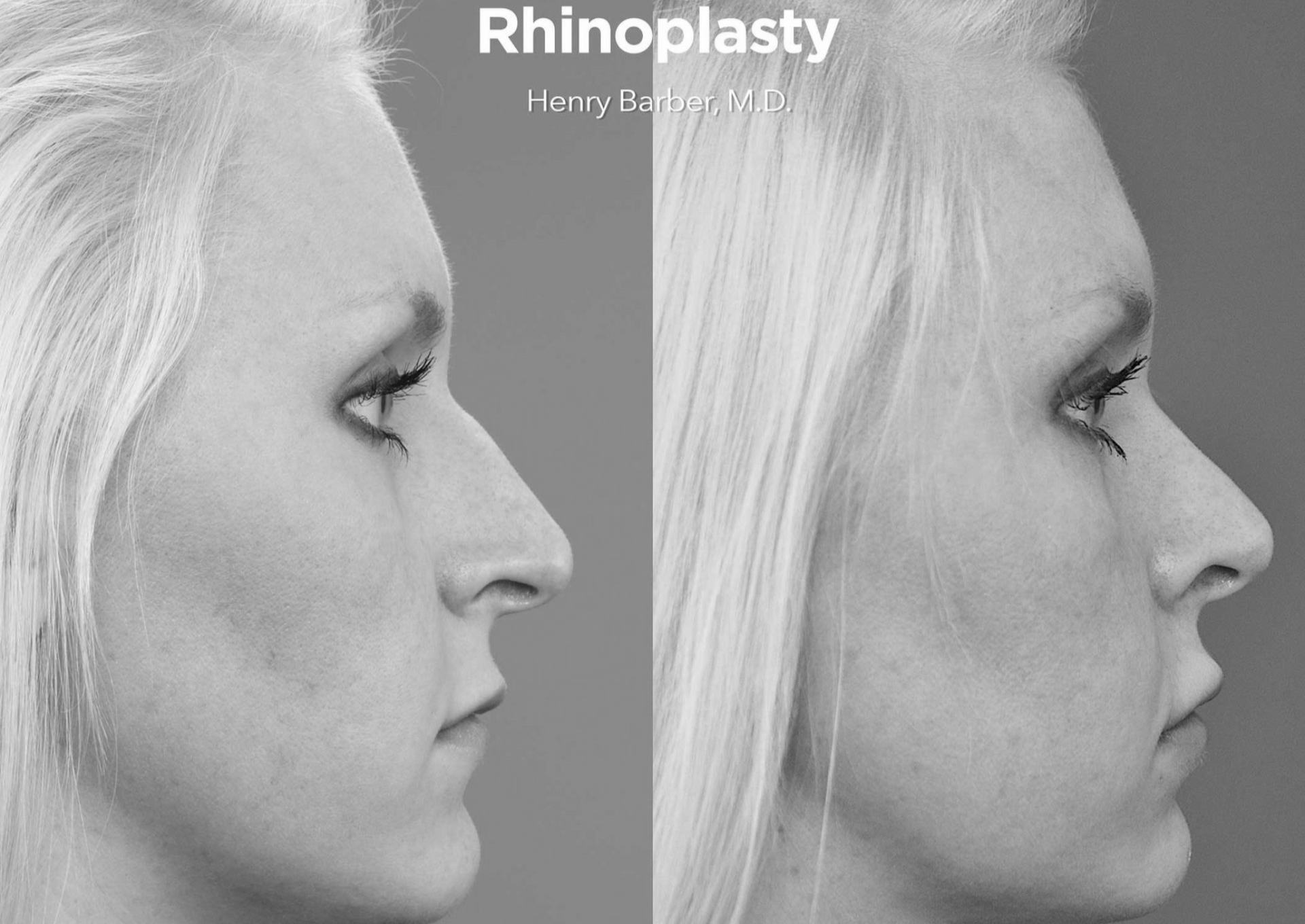 before and after rhinoplasty - barber facial plastic surgery