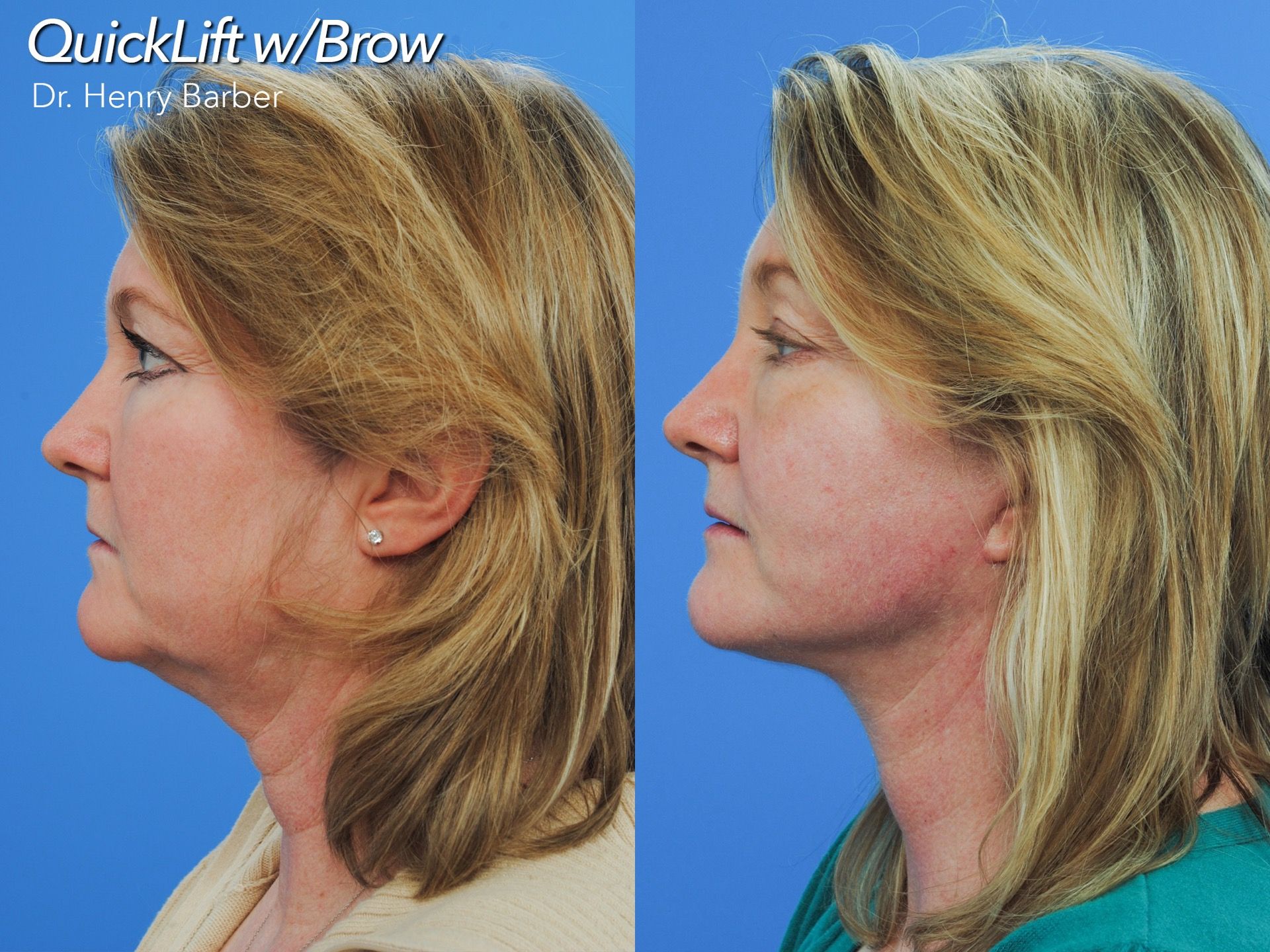 client at barber facial plastic surgery before and after quicklift with brow - mobile al henry barber