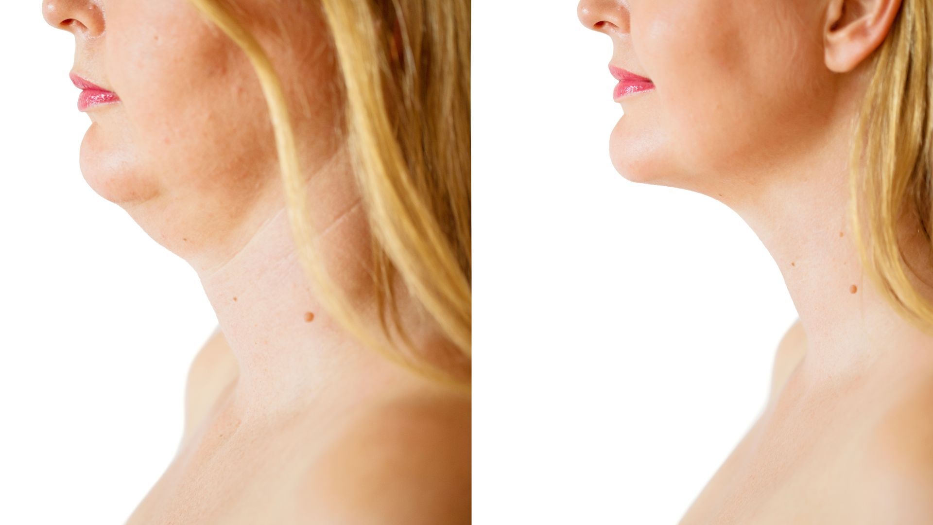 Side-by-side profile of a woman’s neck and jawline before and after cosmetic treatment