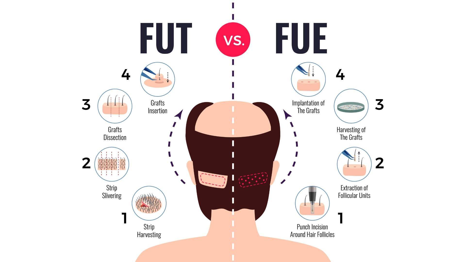 Infographic comparing FUT vs FUE hair transplant methods with labeled step diagrams and a scalp illustration