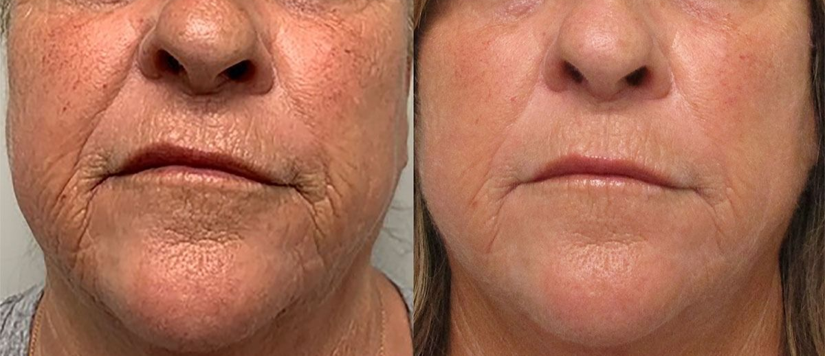 patient at barber facial plastic surgery before and after morpheus8 for face