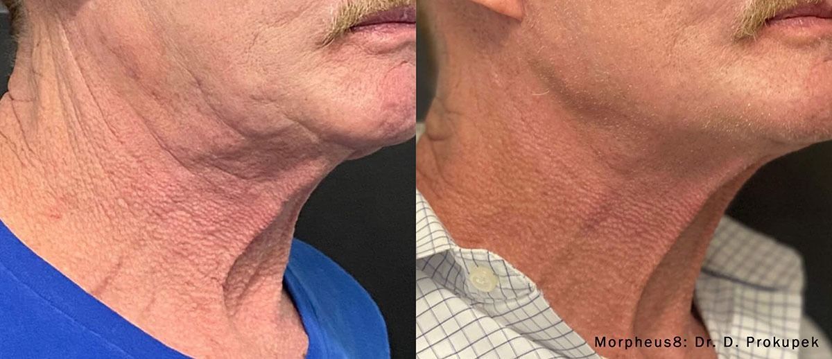 patient at barber facial plastic surgery before and after morpheus8 for neck