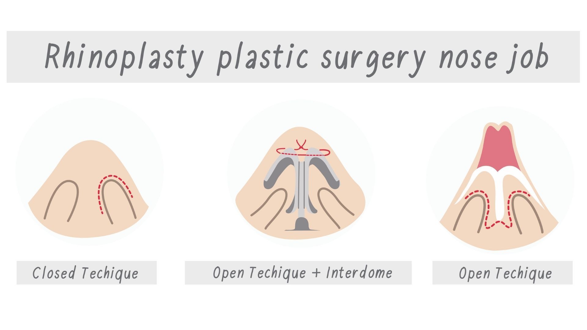 Diagram of rhinoplasty techniques with three nose surgery illustrations and labels on a white background
