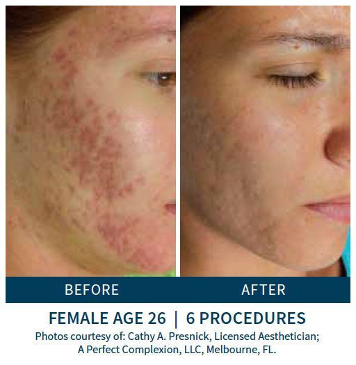 patient before and after skinpen microneedling treatment