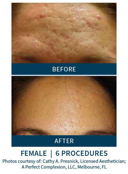 patient before and after skinpen microneedling treatment