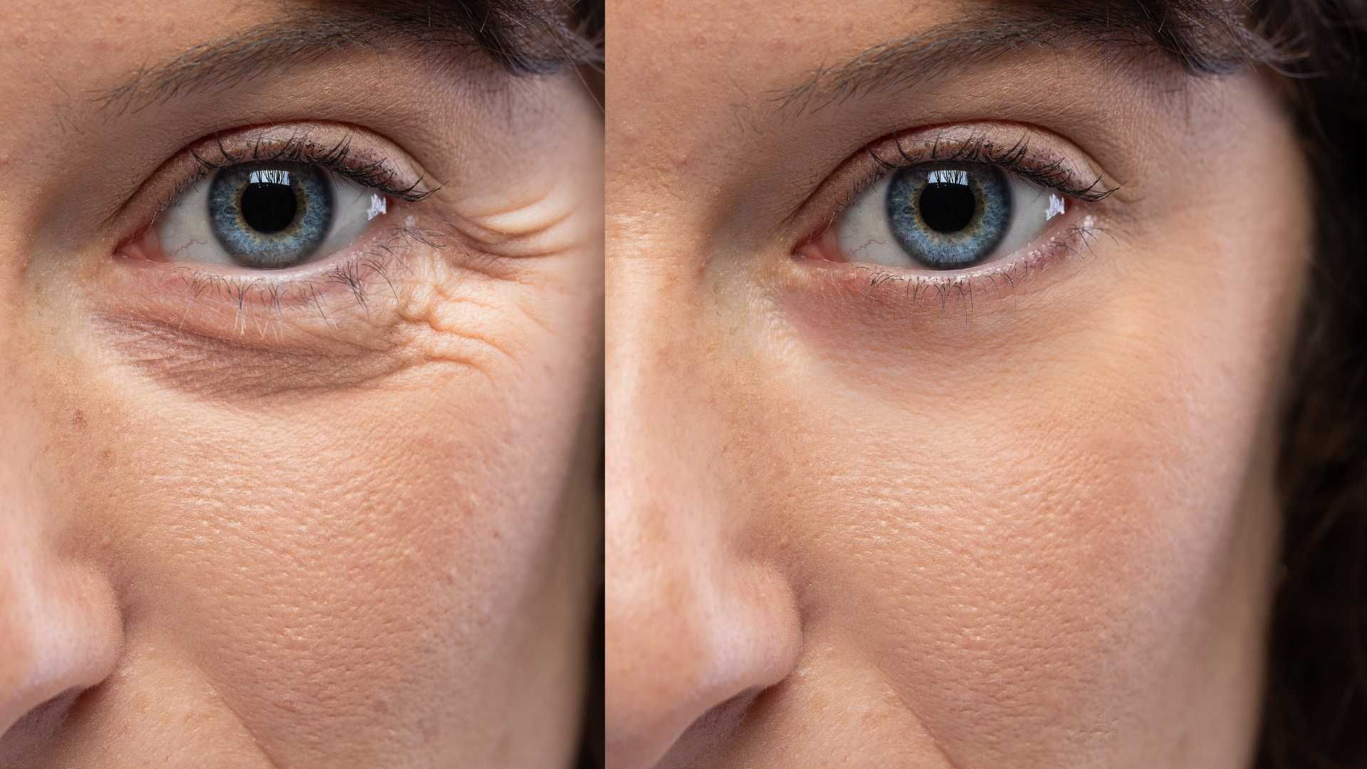 Close-up of an eye area before and after treatment, showing reduced wrinkles and smoother skin