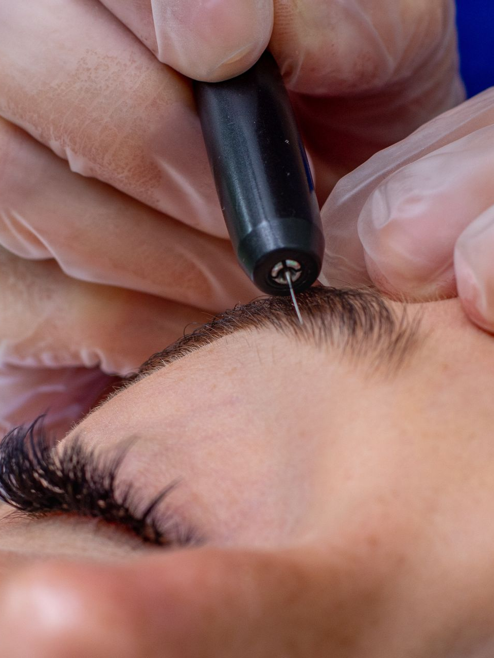 Gloved hands performing a cosmetic tattoo or skin procedure with a handheld needle on skin.