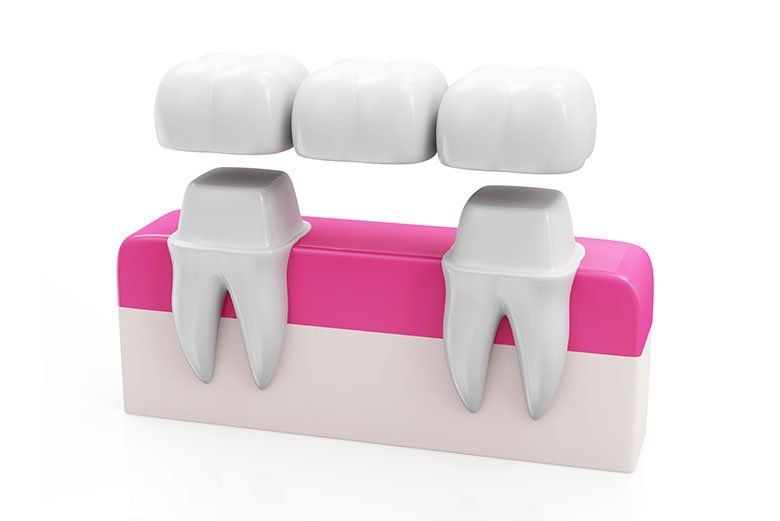 Dental implant diagram with pink gums and three white teeth, showing two implanted teeth supporting a bridge