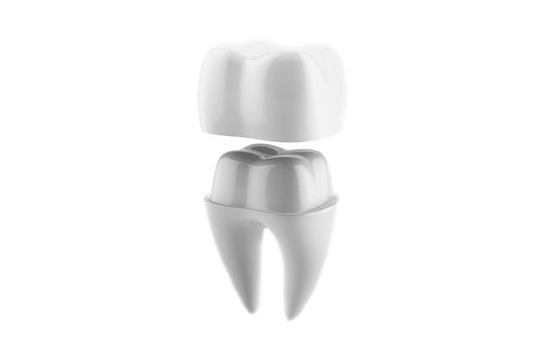 3D rendering of a white molar tooth with a gray dental crown and root.