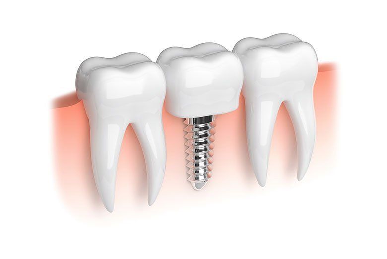 Dental implant between two natural teeth with white crowns and metal screw visible
