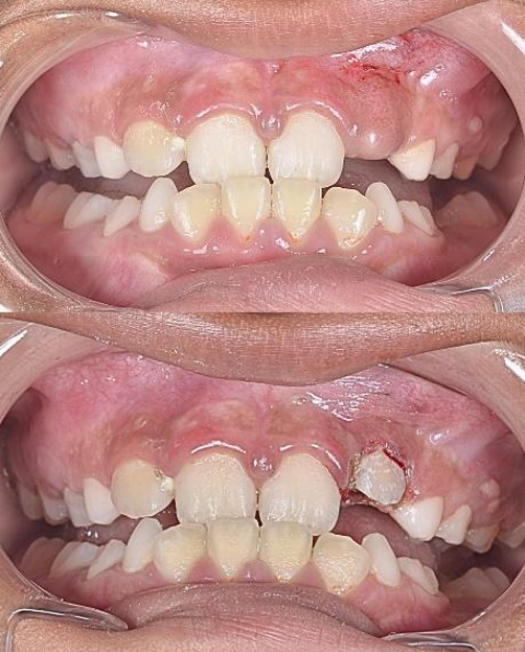 Close-up of a child’s teeth in two open-mouth photos, showing crowding and gaps.