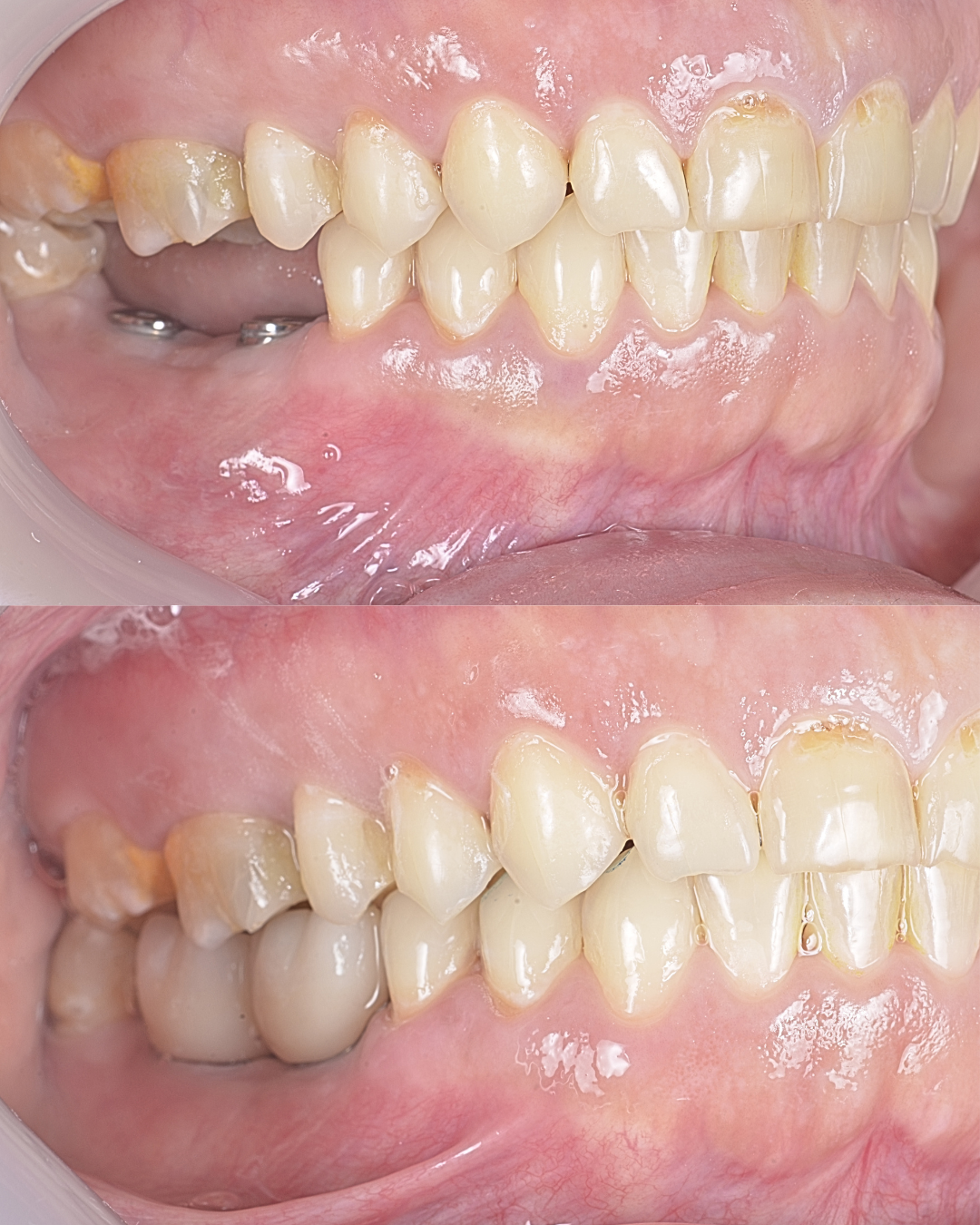 Side-by-side close-up of teeth showing before-and-after dental alignment, with one set more crowded than the other